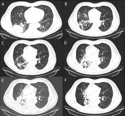 Case Report: Resolution of radiation pneumonitis with androgens and growth hormone